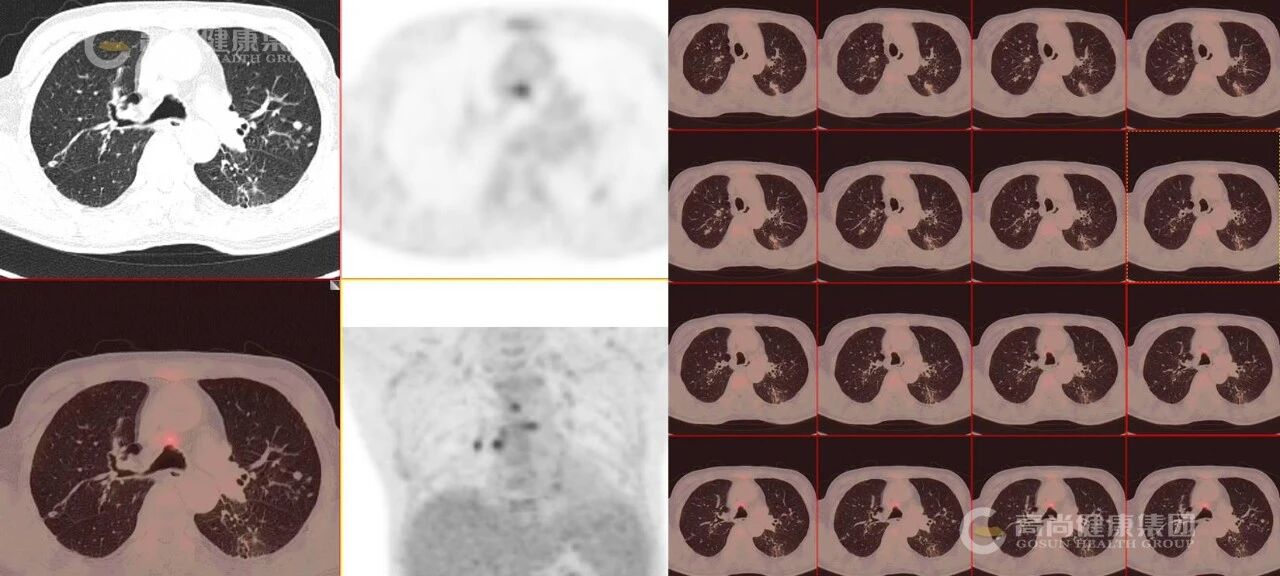 【高尚病例】结节病 PET-CT 病例分享