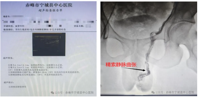 精索静脉曲张微创诊疗 助力青年圆梦军营