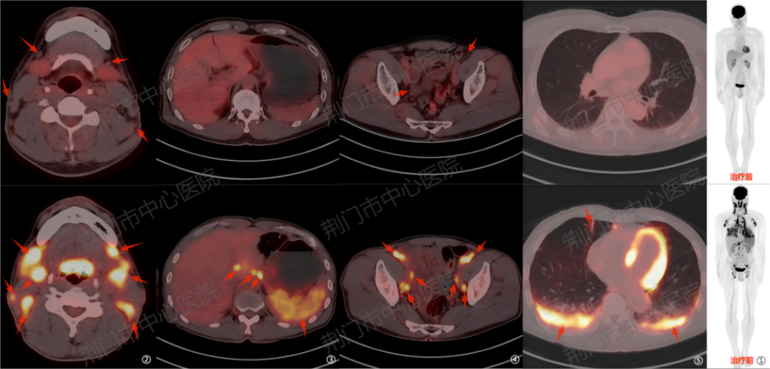 肿瘤患者复查做不做 PET/CT？这张「必要性清单」帮您答疑解惑！
