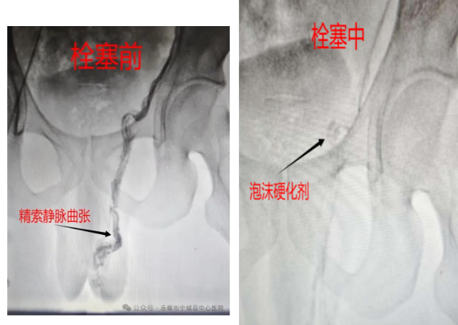 精索静脉曲张微创诊疗 助力青年圆梦军营
