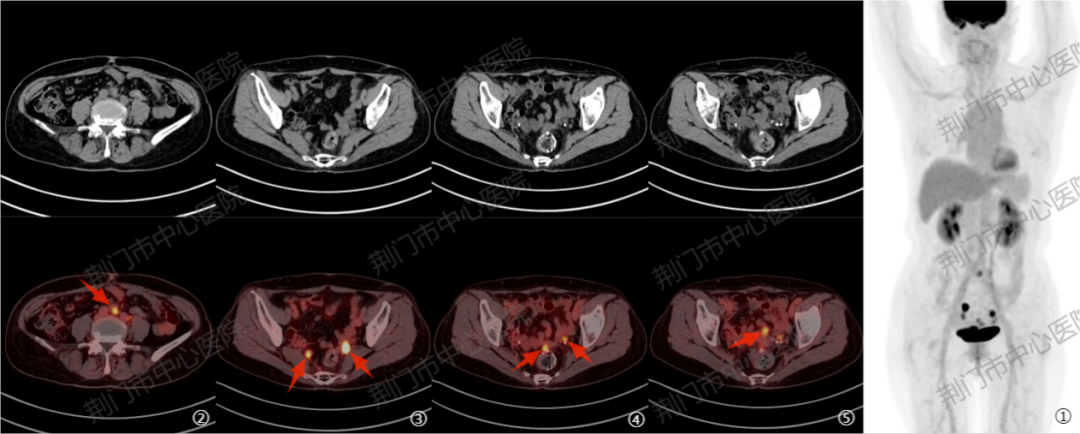 肿瘤患者复查做不做 PET/CT？这张「必要性清单」帮您答疑解惑！