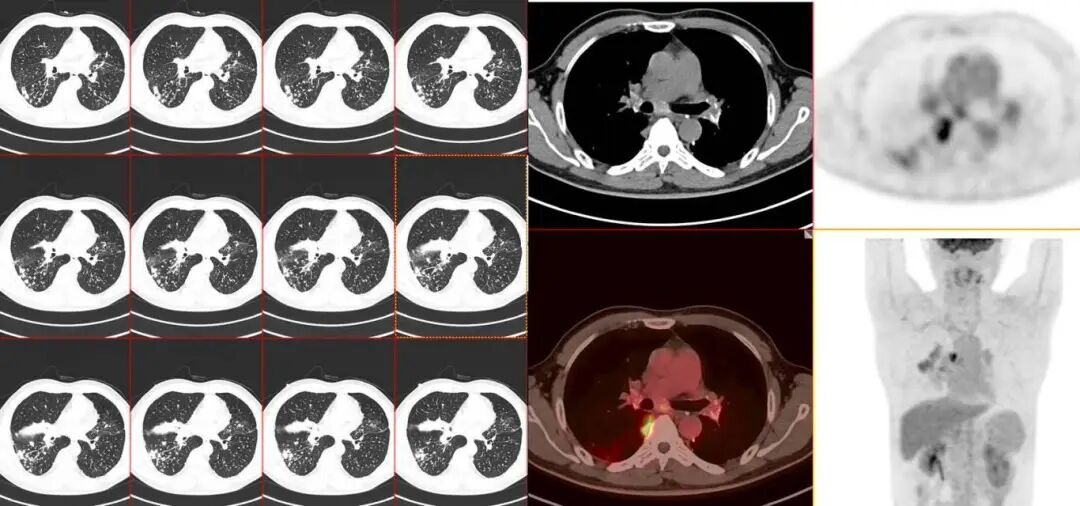 【高尚病例】结节病 PET-CT 病例分享