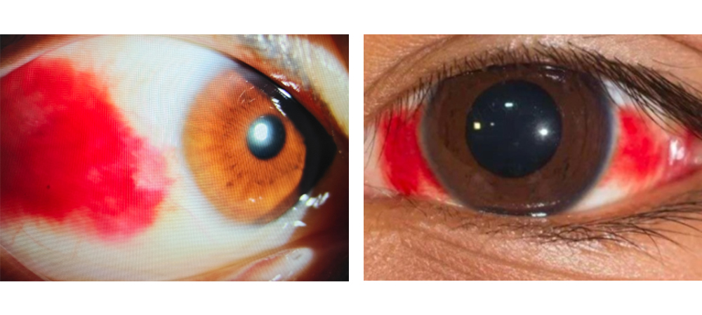 眼睛「红了」莫慌张,科学应对是关键