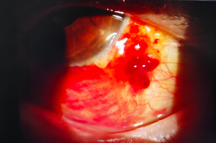 眼睛「红了」莫慌张,科学应对是关键