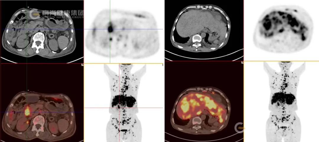 【高尚病例】结节病 PET-CT 病例分享