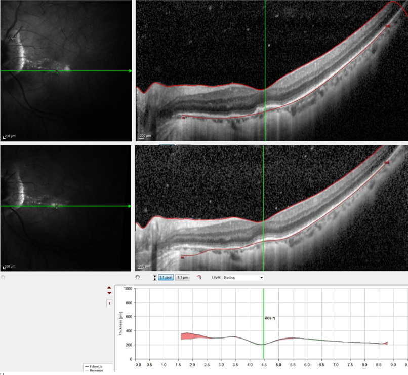 60 岁大叔突发视力骤降查无因，辽宁爱尔眼科医院葡萄膜炎专病门诊精准诊疗护光明
