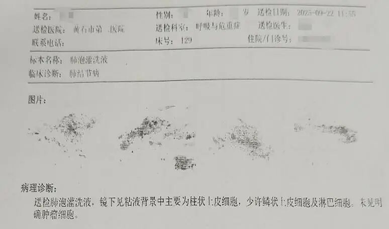 【高尚病例】结节病 PET-CT 病例分享