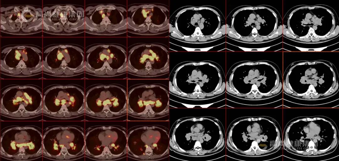 【高尚病例】结节病 PET-CT 病例分享