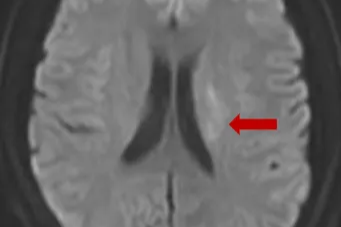 突发「急性脑梗死」，介入取栓助他重获新生