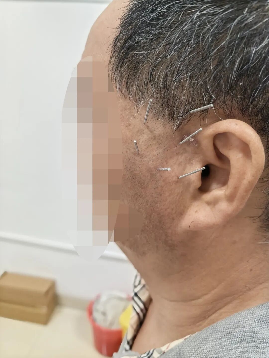 「蛇缠腰」后遗症痛熬 3 年多，疼到性情大变！看医生如何「针」到痛除～