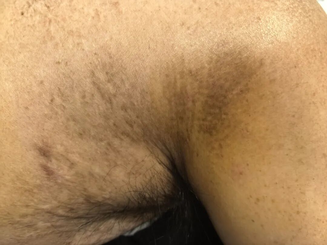 「蛇缠腰」后遗症痛熬 3 年多，疼到性情大变！看医生如何「针」到痛除～