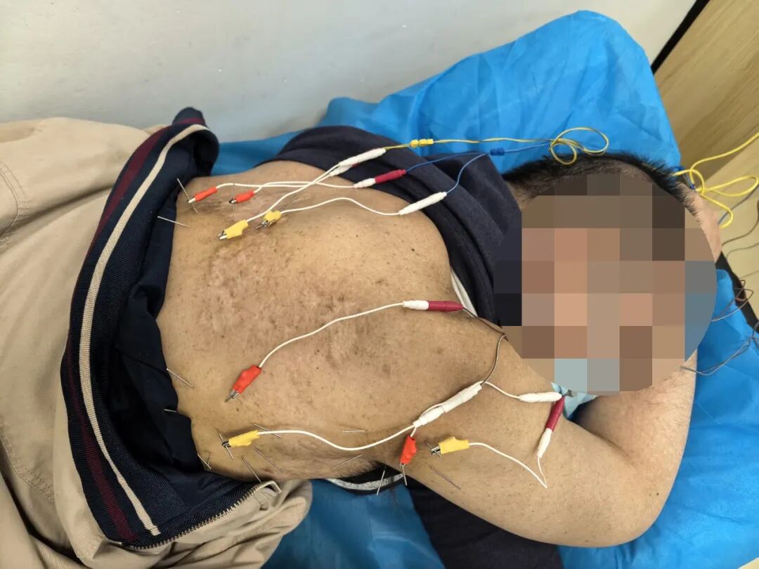 「蛇缠腰」后遗症痛熬 3 年多，疼到性情大变！看医生如何「针」到痛除～