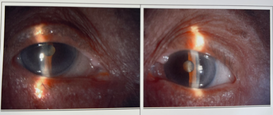 103 岁超高龄老人极硬核合并复杂白内障手术