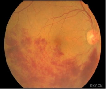 视力下降突然是怎么回事？武汉普瑞眼科许泽骏提醒谨防视网膜血管阻塞