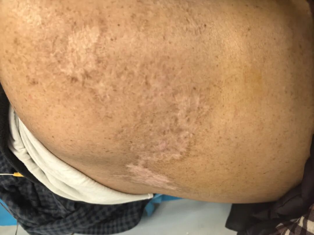 「蛇缠腰」后遗症痛熬 3 年多，疼到性情大变！看医生如何「针」到痛除～