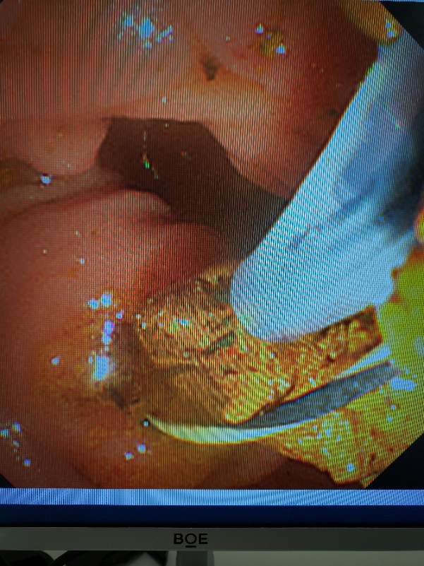94 岁老人巨大胆总管结石,合肥京东方医院高难度 ERCP「无痕」化解危机