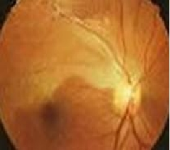 视力下降突然是怎么回事？武汉普瑞眼科许泽骏提醒谨防视网膜血管阻塞