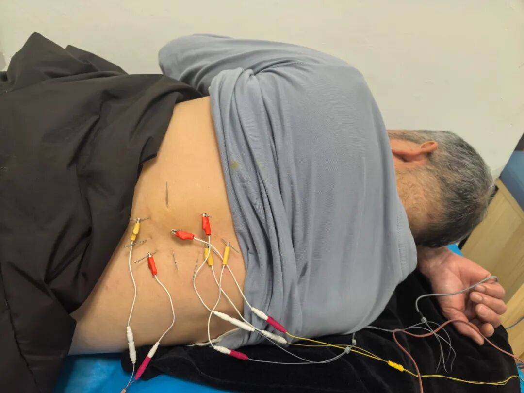 「蛇缠腰」后遗症痛熬 3 年多，疼到性情大变！看医生如何「针」到痛除～