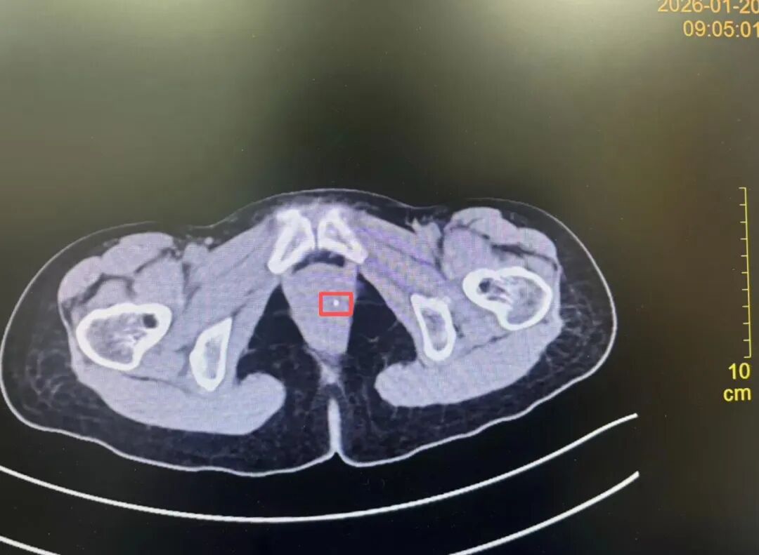 三年之「坠」终解除——异物取出