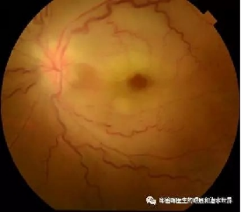 视力下降突然是怎么回事？武汉普瑞眼科许泽骏提醒谨防视网膜血管阻塞