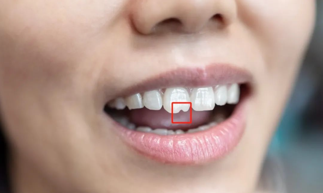 门牙上的「豁口」真是嗑瓜子惹的祸？春节快到了！急解！