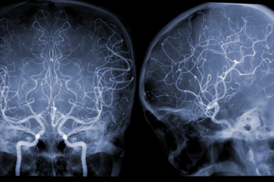 脑卒中会遗传吗？会遗传，但避开这些「误区」，或可抵消遗传风险！