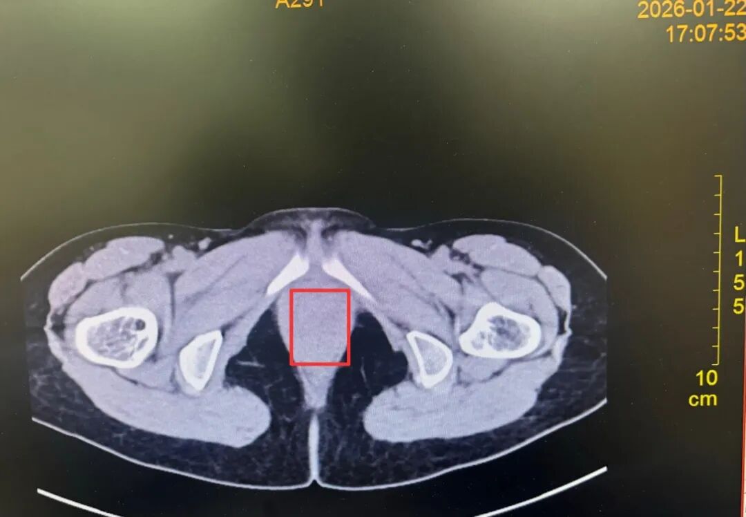 三年之「坠」终解除——异物取出