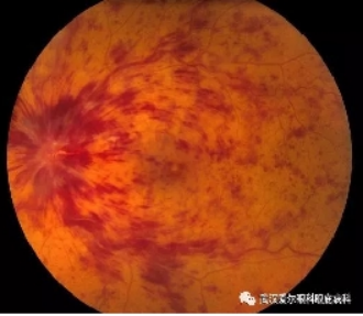 视力下降突然是怎么回事？武汉普瑞眼科许泽骏提醒谨防视网膜血管阻塞