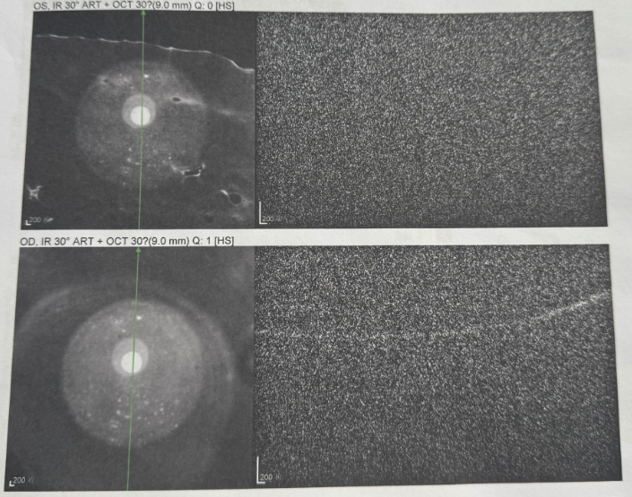 病例分享:103 岁超高龄老人瞳孔粘连+V 级(极硬核)白内障案例