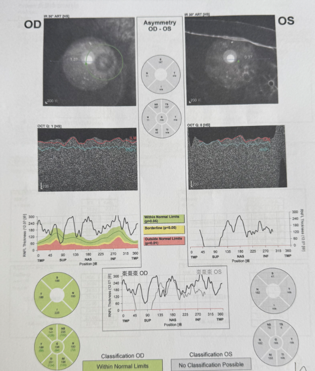 病例分享:103 岁超高龄老人瞳孔粘连+V 级(极硬核)白内障案例