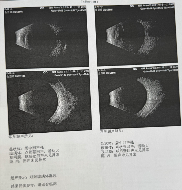 病例分享:103 岁超高龄老人瞳孔粘连+V 级(极硬核)白内障案例