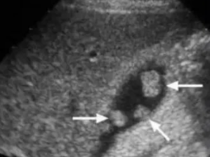 查出胆囊息肉，会癌变吗？