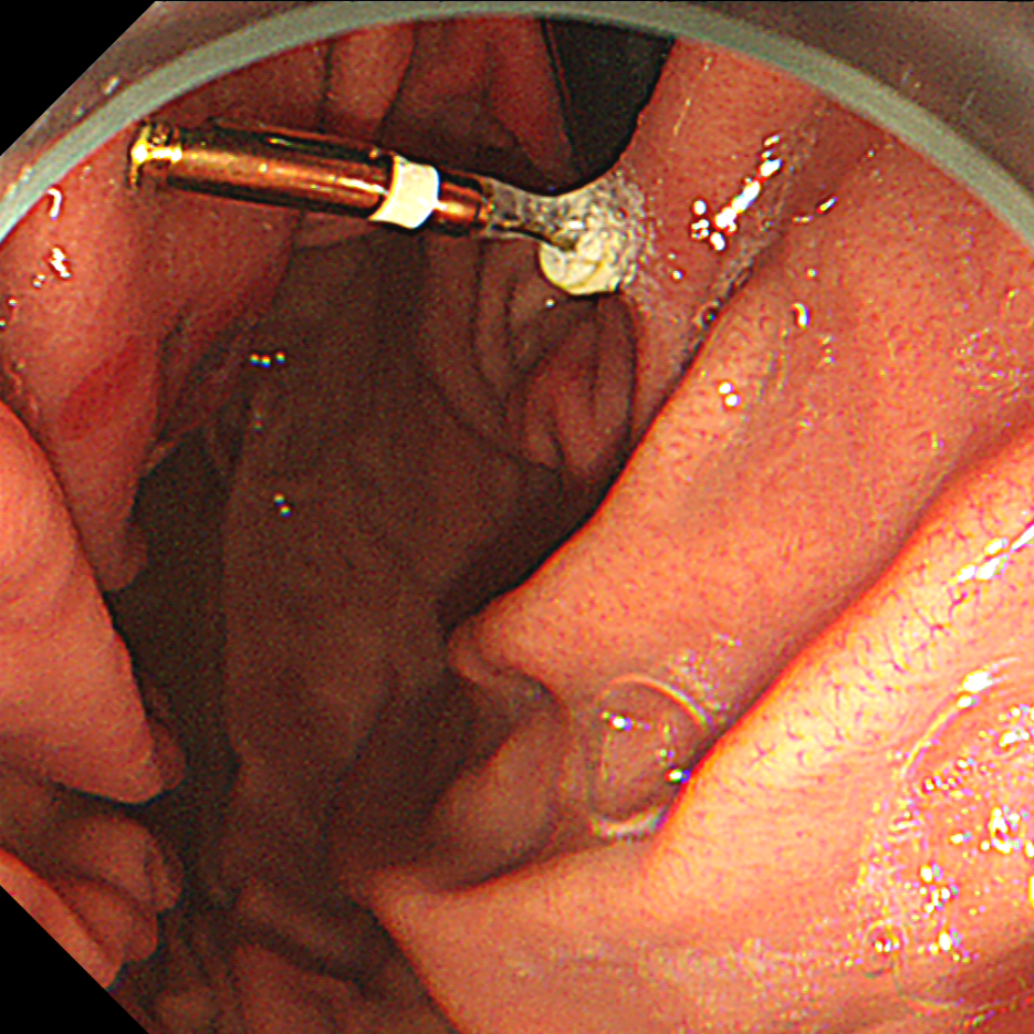「玻璃球」、钉子都敢吞?误吞异物别拖延!超 24 小时,并发症风险直接翻倍