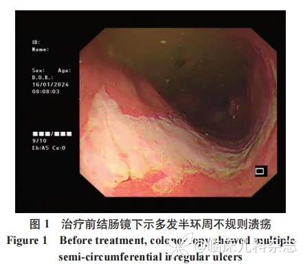 五次入院，狼疮性肠炎还是炎症性肠病？1 例合并胃肠道症状的系统性红斑狼疮诊治报告