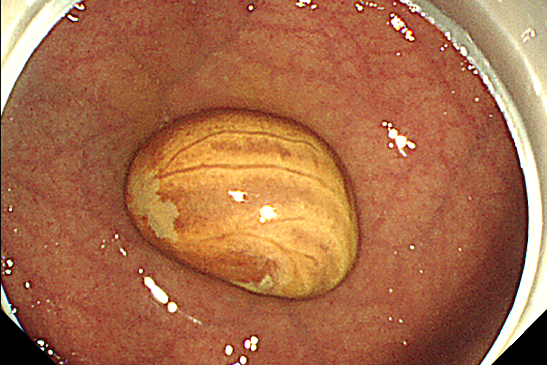 「玻璃球」、钉子都敢吞?误吞异物别拖延!超 24 小时,并发症风险直接翻倍