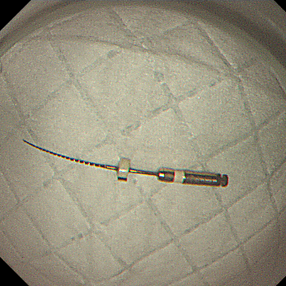 「玻璃球」、钉子都敢吞?误吞异物别拖延!超 24 小时,并发症风险直接翻倍