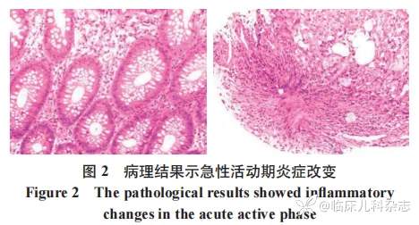五次入院，狼疮性肠炎还是炎症性肠病？1 例合并胃肠道症状的系统性红斑狼疮诊治报告