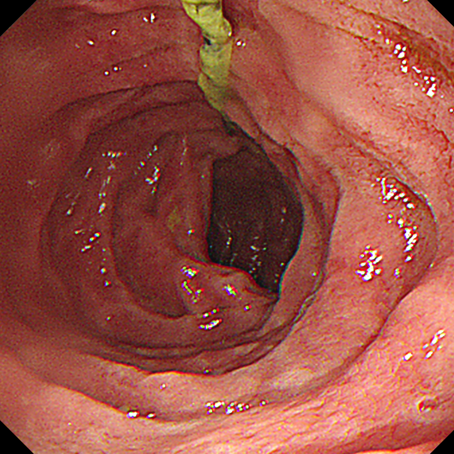 「玻璃球」、钉子都敢吞?误吞异物别拖延!超 24 小时,并发症风险直接翻倍