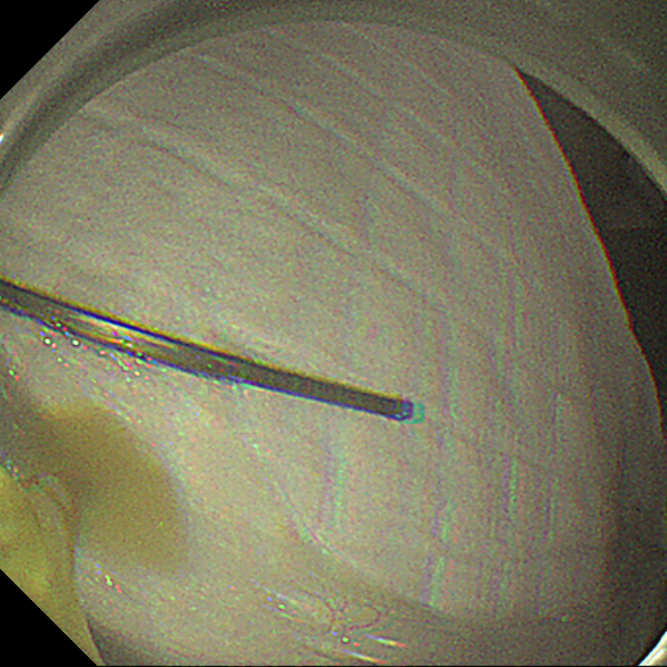 「玻璃球」、钉子都敢吞?误吞异物别拖延!超 24 小时,并发症风险直接翻倍