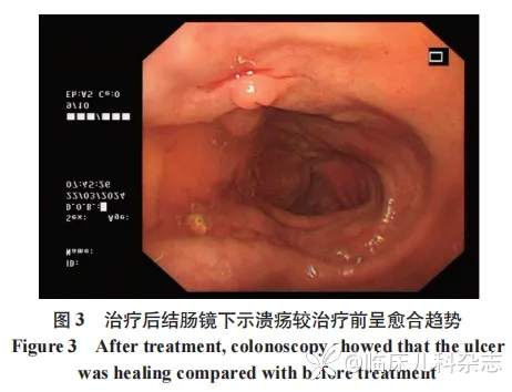 五次入院，狼疮性肠炎还是炎症性肠病？1 例合并胃肠道症状的系统性红斑狼疮诊治报告