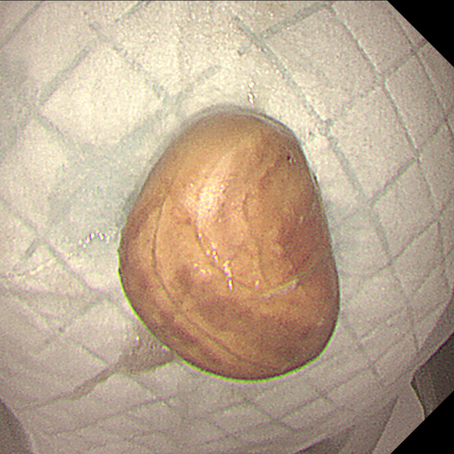 「玻璃球」、钉子都敢吞?误吞异物别拖延!超 24 小时,并发症风险直接翻倍