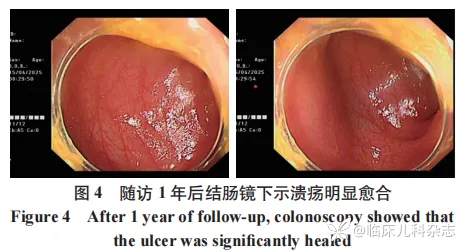 五次入院，狼疮性肠炎还是炎症性肠病？1 例合并胃肠道症状的系统性红斑狼疮诊治报告