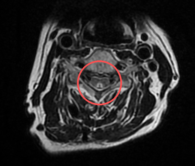 长期缺少这种维生素,义乌大妈神经差点被「烧」坏