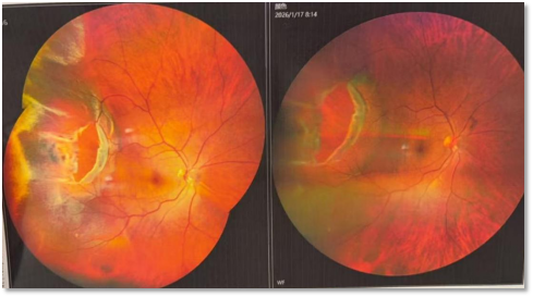 韩清院长微创球囊植入成功治疗赤道后大孔孔源性视网膜脱离