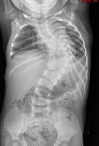 10 年矫治，武汉医生帮女孩拉直「乱成麻」的脊柱