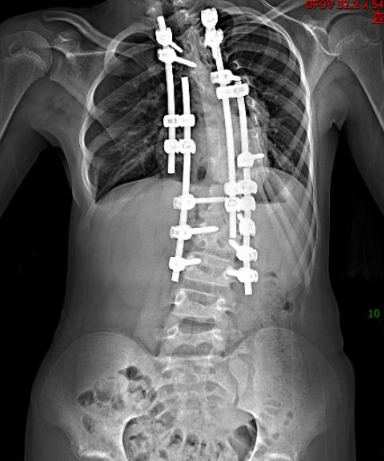10 年矫治，武汉医生帮女孩拉直「乱成麻」的脊柱