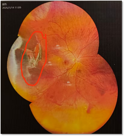 韩清院长微创球囊植入成功治疗赤道后大孔孔源性视网膜脱离