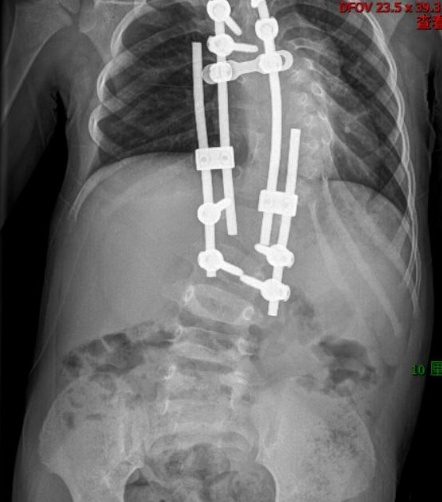 10 年矫治，武汉医生帮女孩拉直「乱成麻」的脊柱