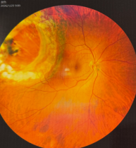 韩清院长微创球囊植入成功治疗赤道后大孔孔源性视网膜脱离