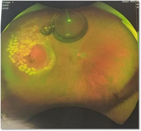 韩清院长微创球囊植入成功治疗赤道后大孔孔源性视网膜脱离